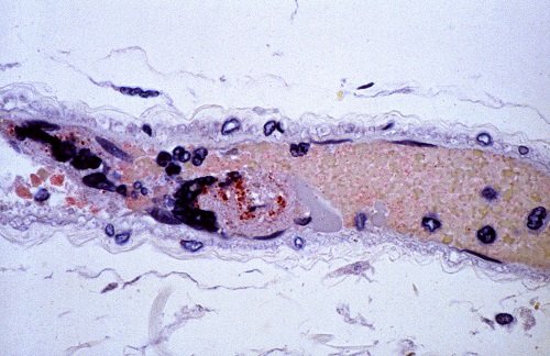 nipah virus symptoms